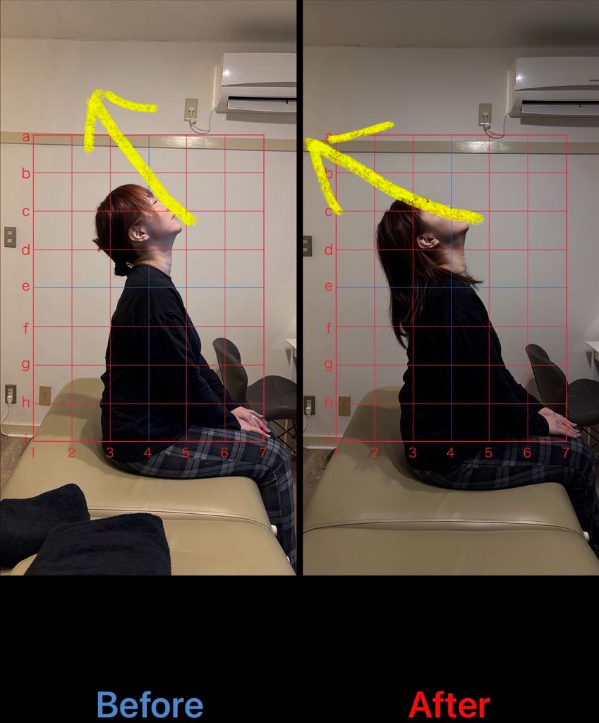 猫背矯正 施術結果8