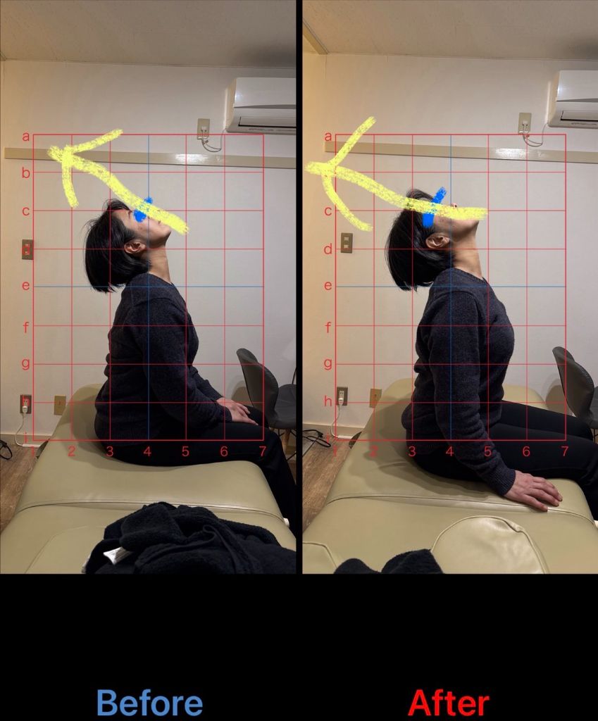 猫背矯正 施術結果10