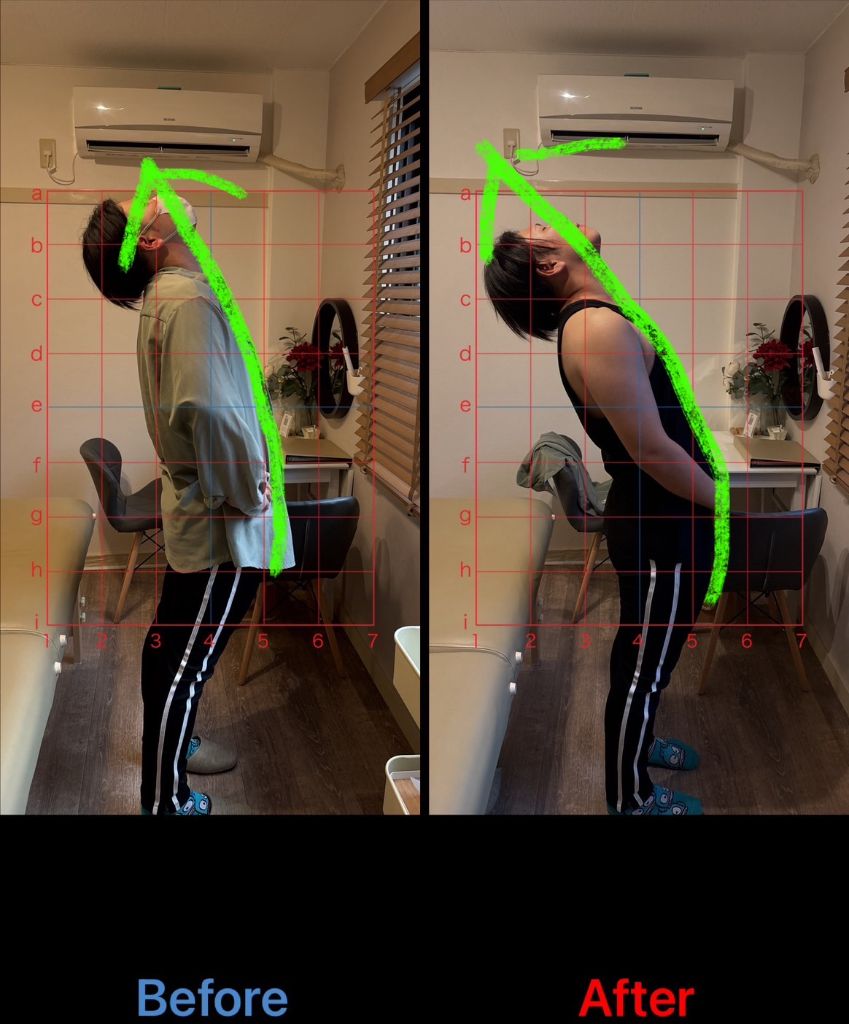 姿勢改善 施術結果13