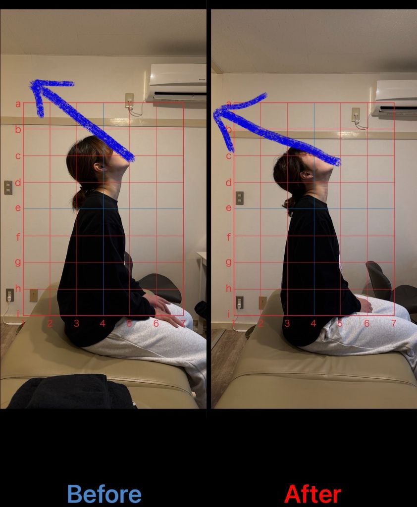 姿勢改善 施術結果14