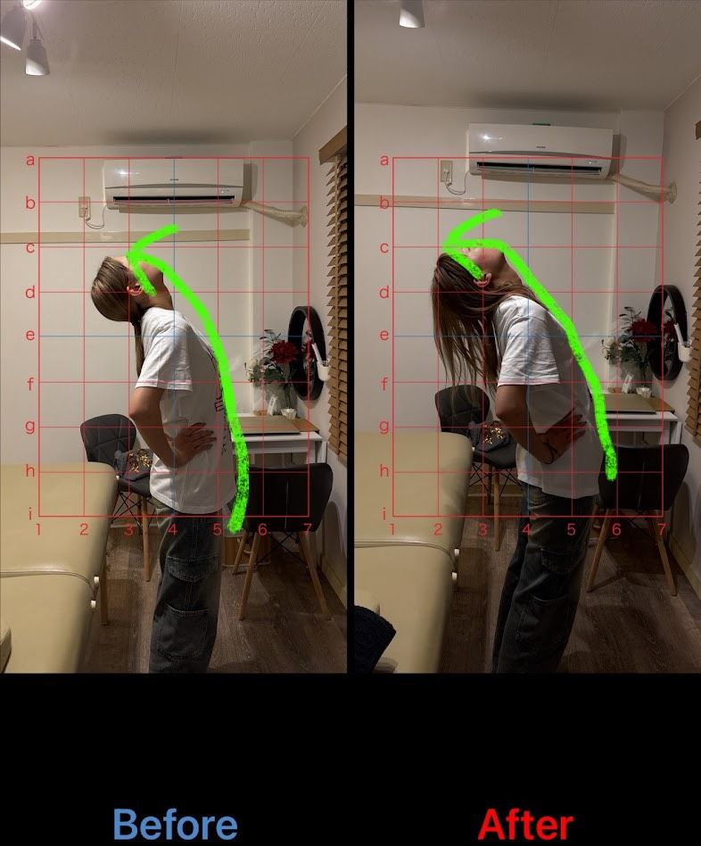 猫背矯正 施術結果15