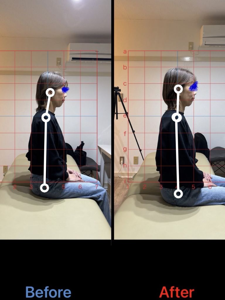 猫背矯正 施術結果18
