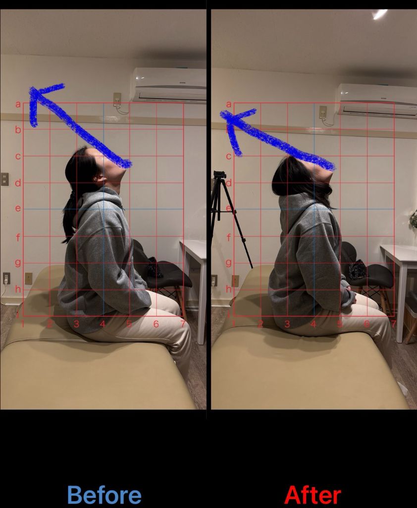 姿勢改善 施術結果19