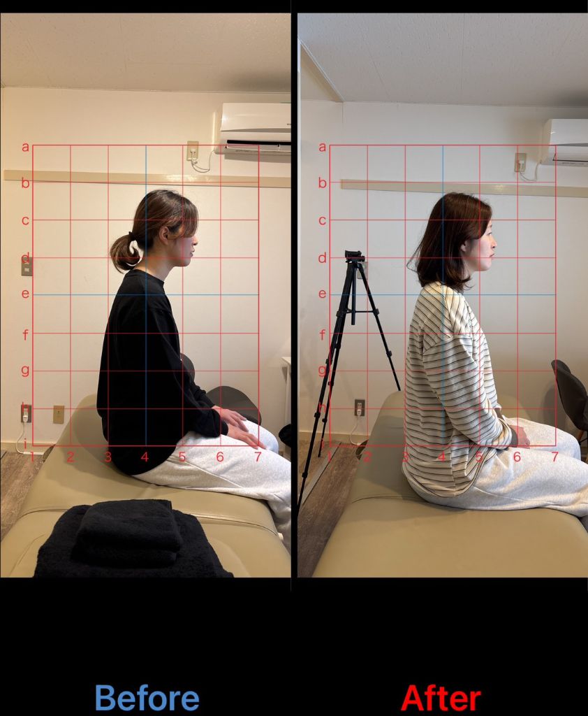 猫背矯正 施術結果22