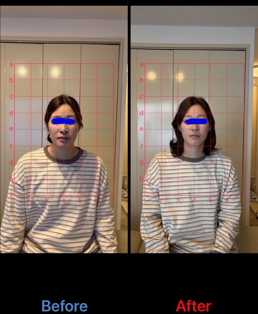 猫背矯正 施術結果24